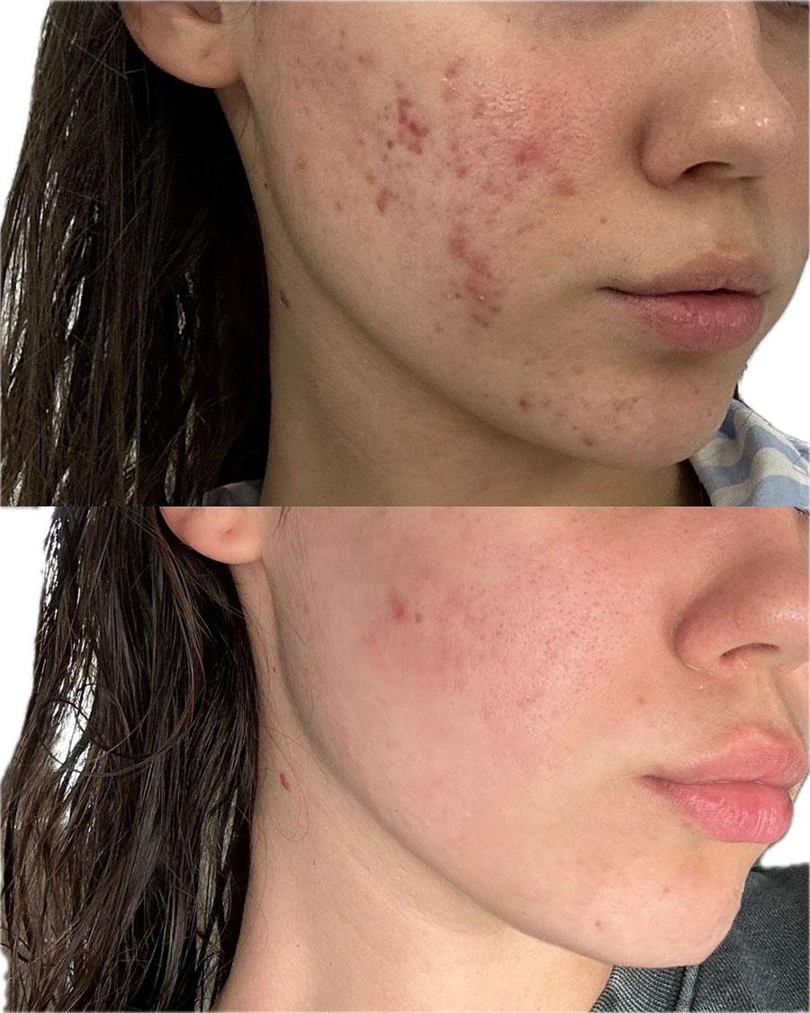 Acne Scar Treatment Perth