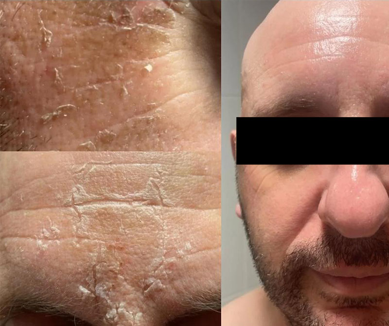 iris-beauty-1-Skin-Treatment